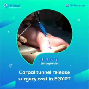 The cost of carpal tunnel release surgery in Egypt - Shifaay