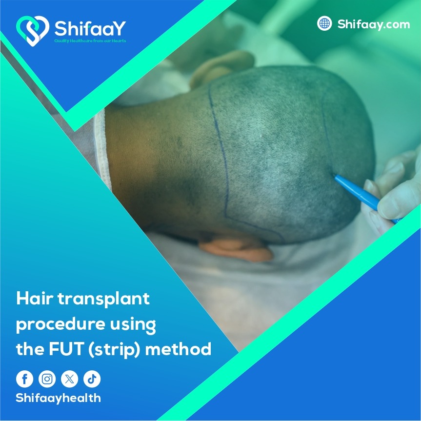 Hair transplantation using the strip method FUT