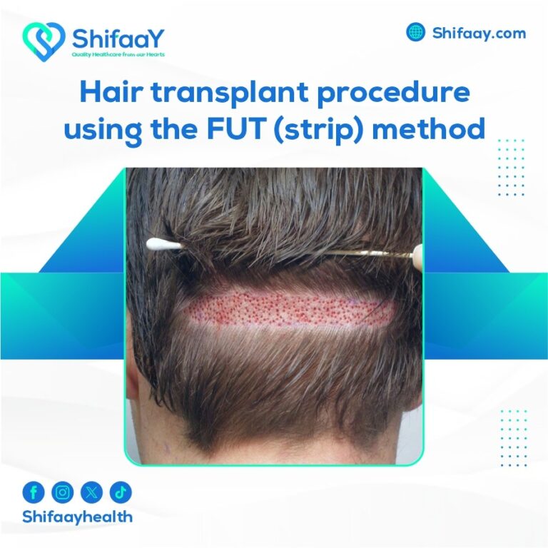 Hair transplantation using the strip method FUT