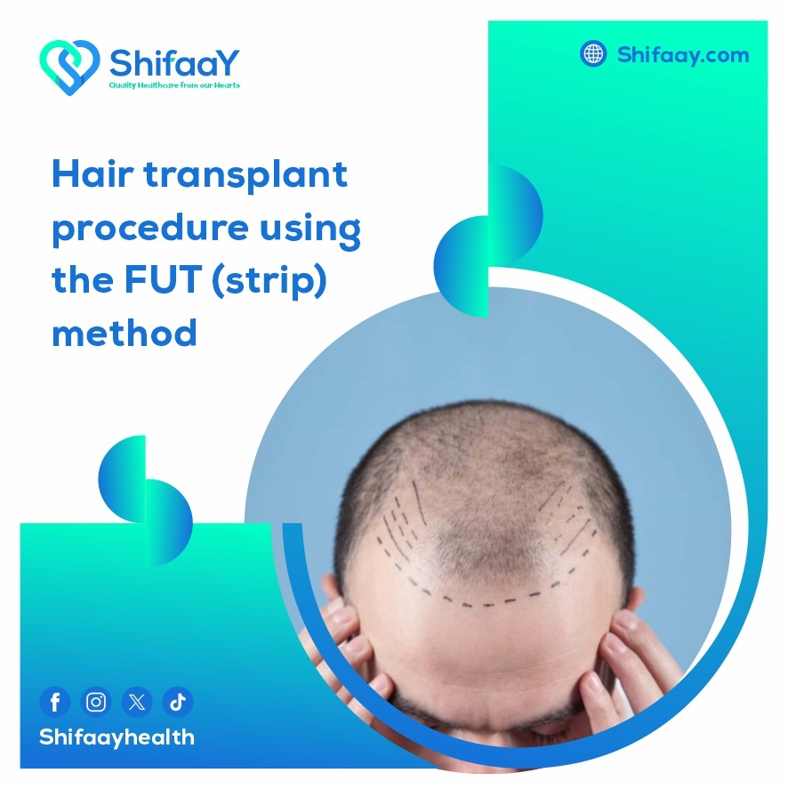 Hair transplantation using the strip method FUT