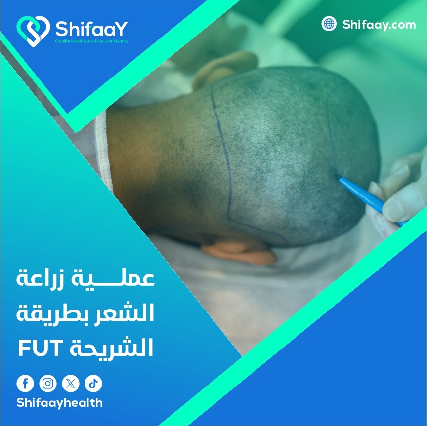 عملية زراعة الشعر بطريقة الشريحة FUT