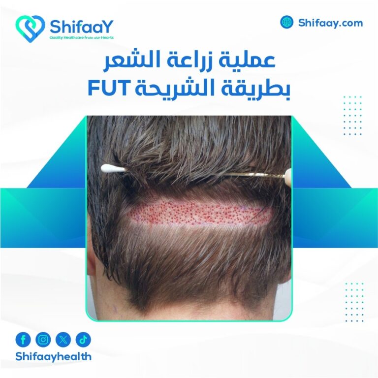 عملية زراعة الشعر بطريقة الشريحة FUT