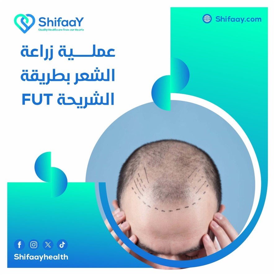 عملية زراعة الشعر بطريقة الشريحة FUT