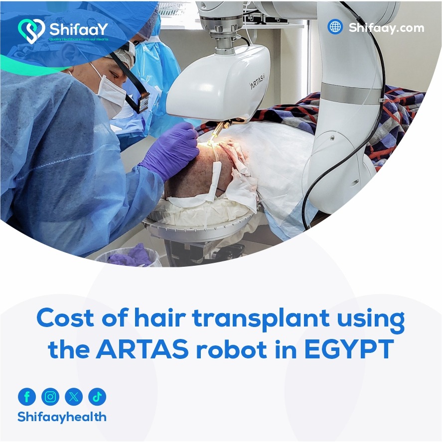 The cost of robotic hair transplantation in Egypt ARTAS