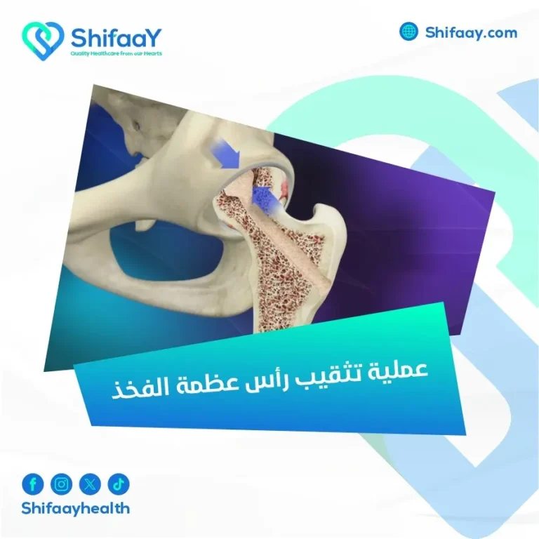 عملية تثقيب رأس عظمة الفخذ