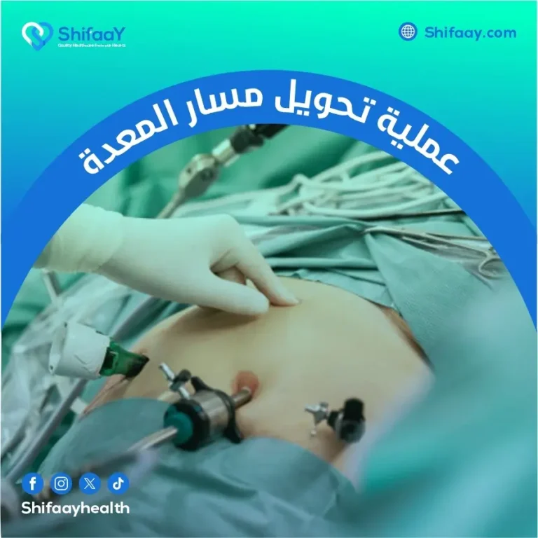 عملية تحويل مسار المعدة