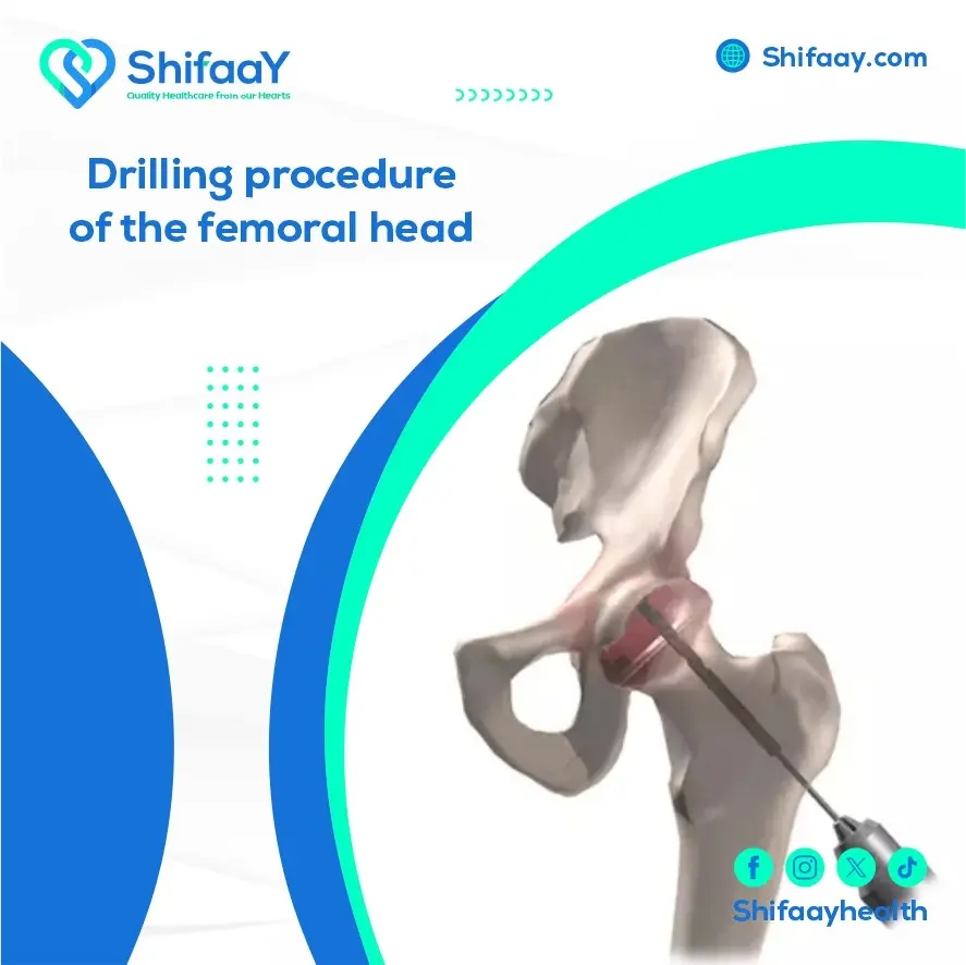 Femoral Head Drilling Procedure 1 Femoral Head Drilling Procedure