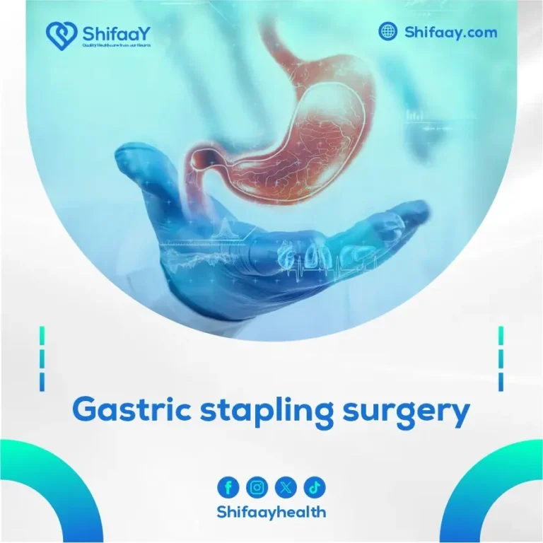 Gastric Stapling Surgery