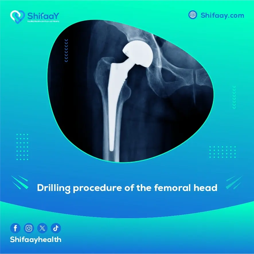 Femoral Head Drilling Procedure 2 Femoral Head Drilling Procedure