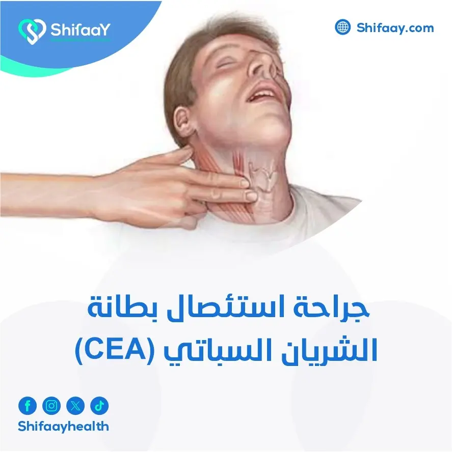 جراحة استئصال بطانة الشريان السباتي (CEA) 2 جراحة استئصال بطانة الشريان السباتي (CEA)