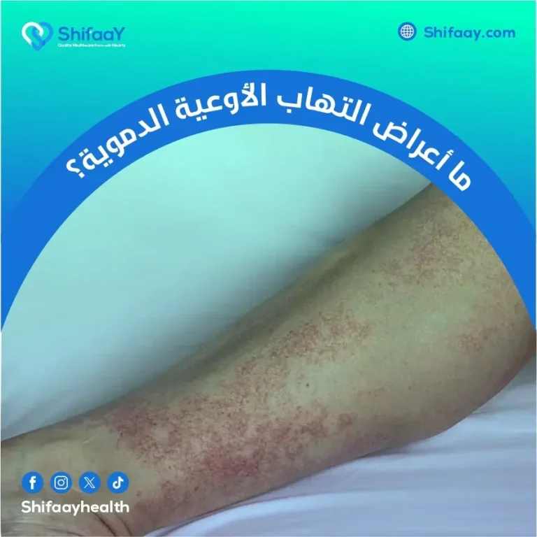أعراض التهاب الأوعية الدموية وعلاجها
