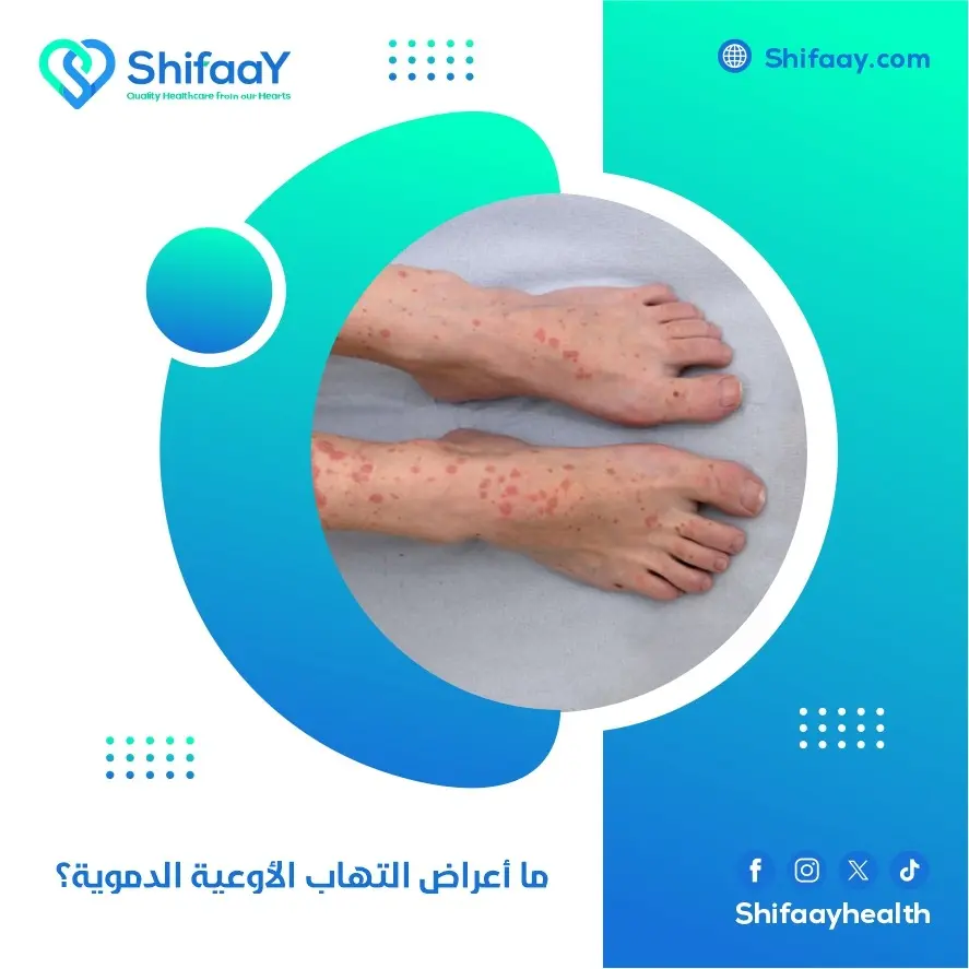 أعراض التهاب الأوعية الدموية وعلاجها 1 التهاب الأوعية الدموية
