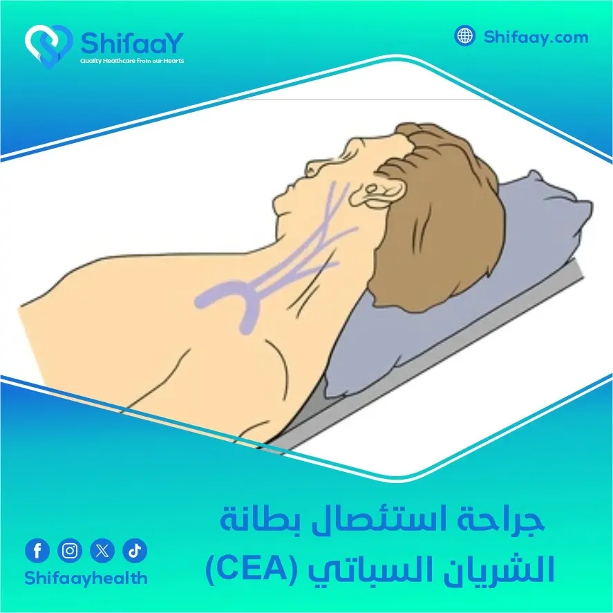 جراحة استئصال بطانة الشريان السباتي (CEA) 1 جراحة استئصال بطانة الشريان السباتي (CEA)
