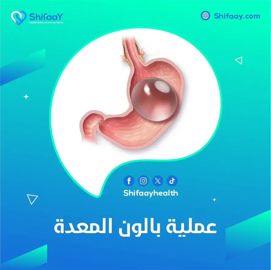 ما هي عملية بالون المعدة 1 عملية بالون المعدة