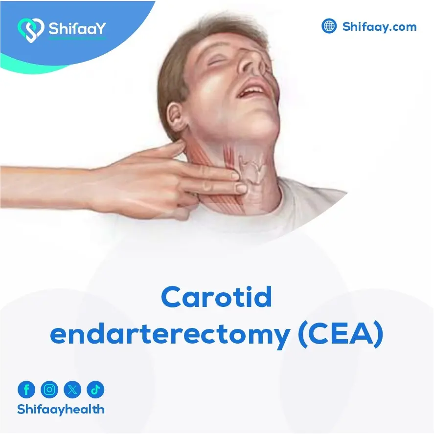 Carotid Endarterectomy (CEA) 1 Carotid Endarterectomy (CEA)