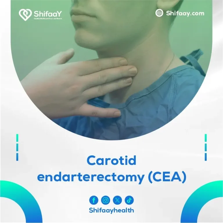 Carotid Endarterectomy (CEA)