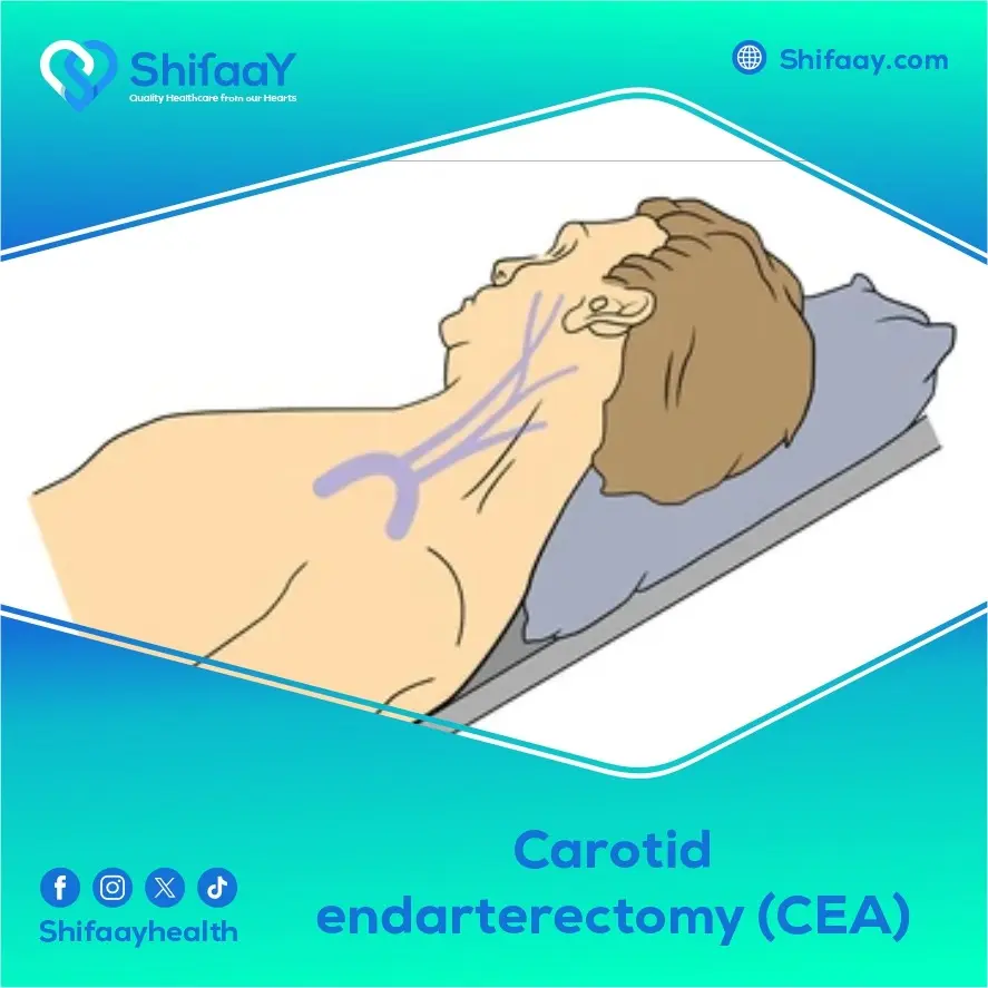 Carotid Endarterectomy (CEA) 2 Carotid Endarterectomy (CEA)