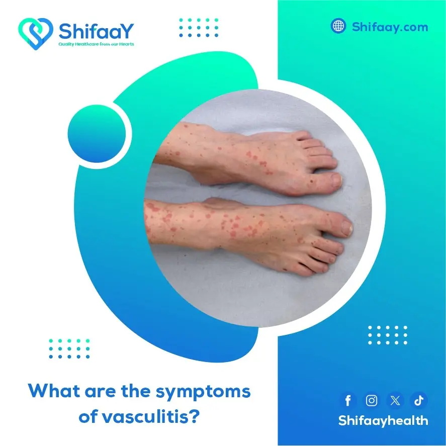 What are the symptoms of vasculitis? 2 Vasculitis