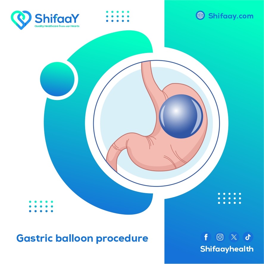 What is the Gastric Balloon Procedure? 2 Gastric Balloon Procedure