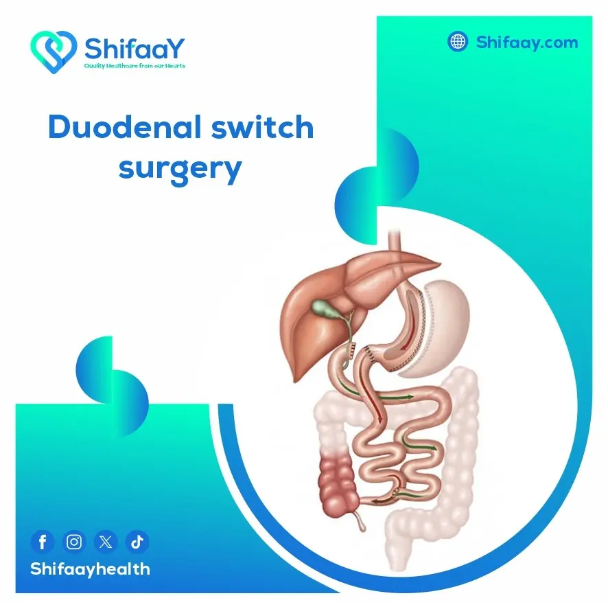 Duodenal switch surgery 1 Duodenal switch surgery
