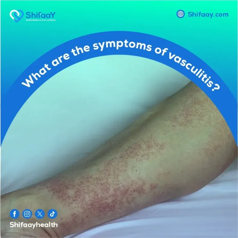 What are the symptoms of vasculitis?