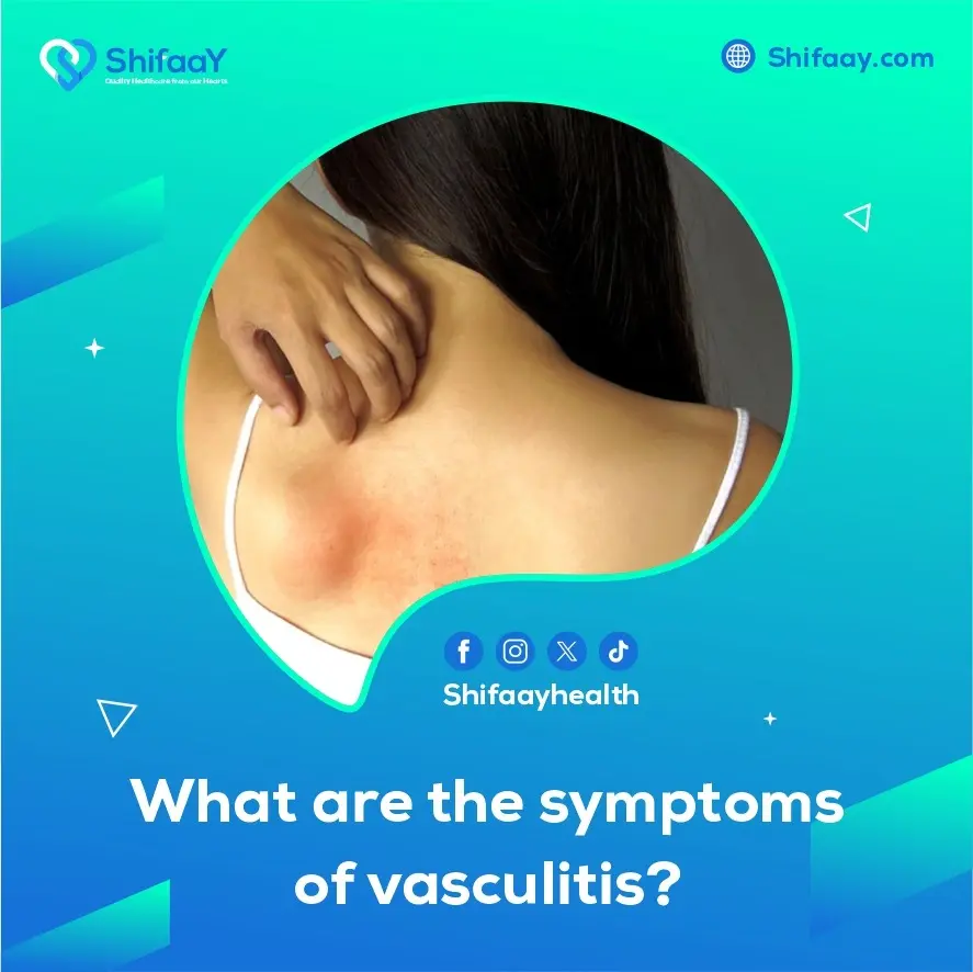 What are the symptoms of vasculitis? 1 Vasculitis