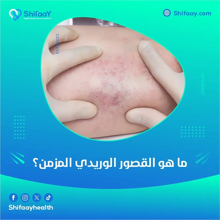 ما هو القصور الوريدي المزمن؟ 2 القصور الوريدي المزمن
