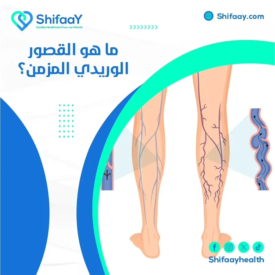 ما هو القصور الوريدي المزمن؟ 1 القصور الوريدي المزمن