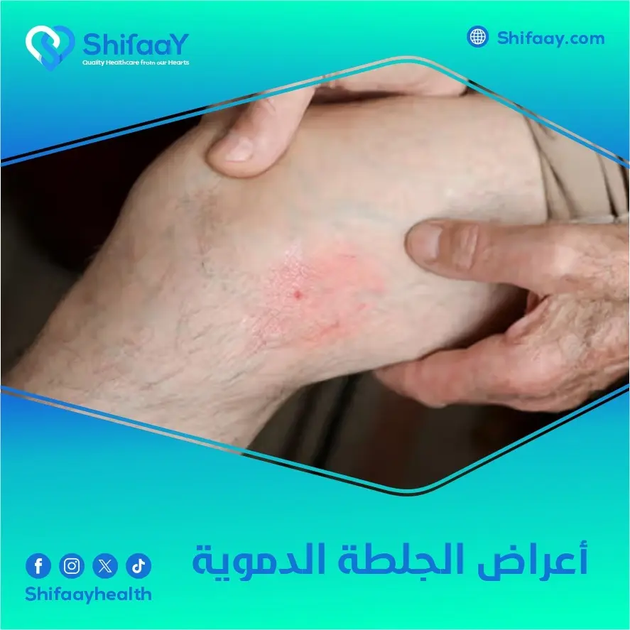 أعراض الجلطة الدموية