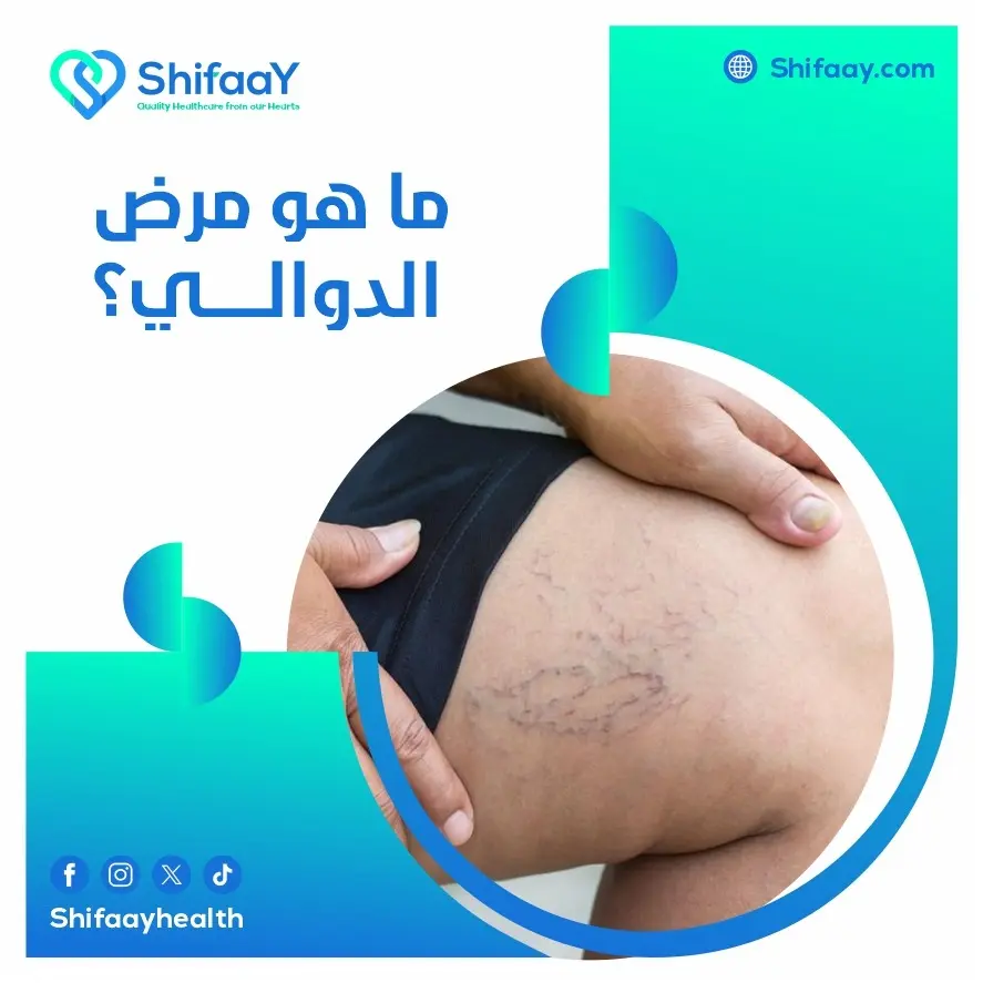 ما هو مرض الدوالي؟ 1 مرض الدوالي