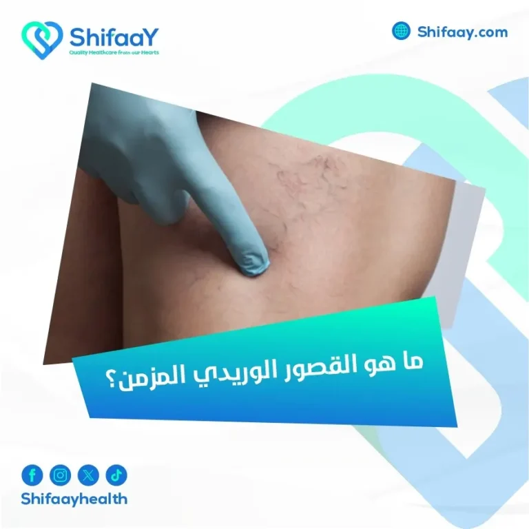 ما هو القصور الوريدي المزمن؟
