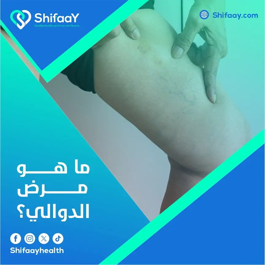ما هو مرض الدوالي؟ 2 مرض الدوالي