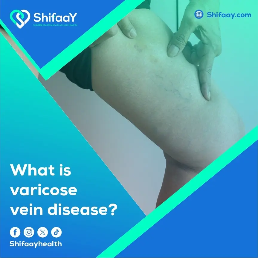 Chronic Venous Insufficiency