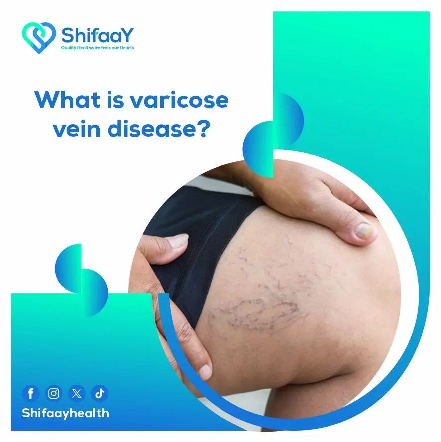 What is Varicose Vein Disease? 1 What is Varicose Vein Disease?