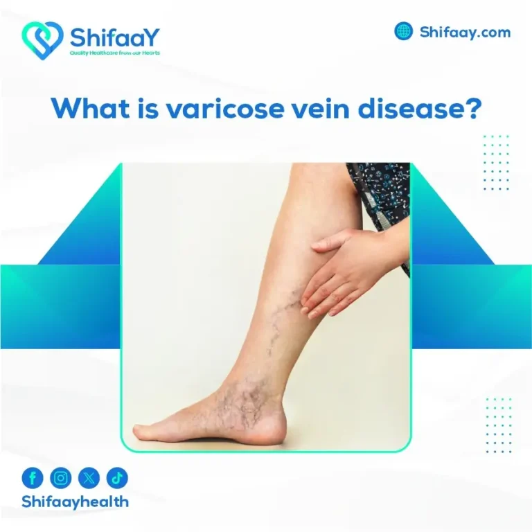 What is Varicose Vein Disease?