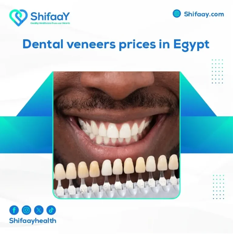 Dental veneers prices in Egypt