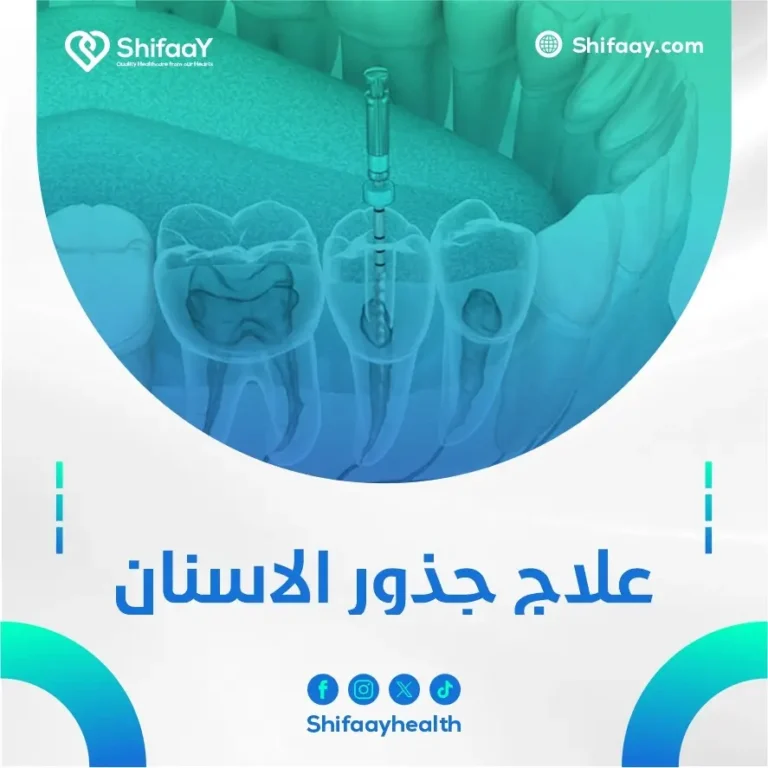 علاج جذور الاسنان
