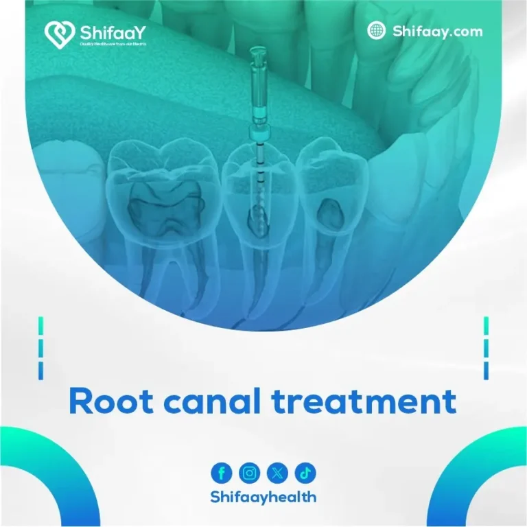 root canal treatment