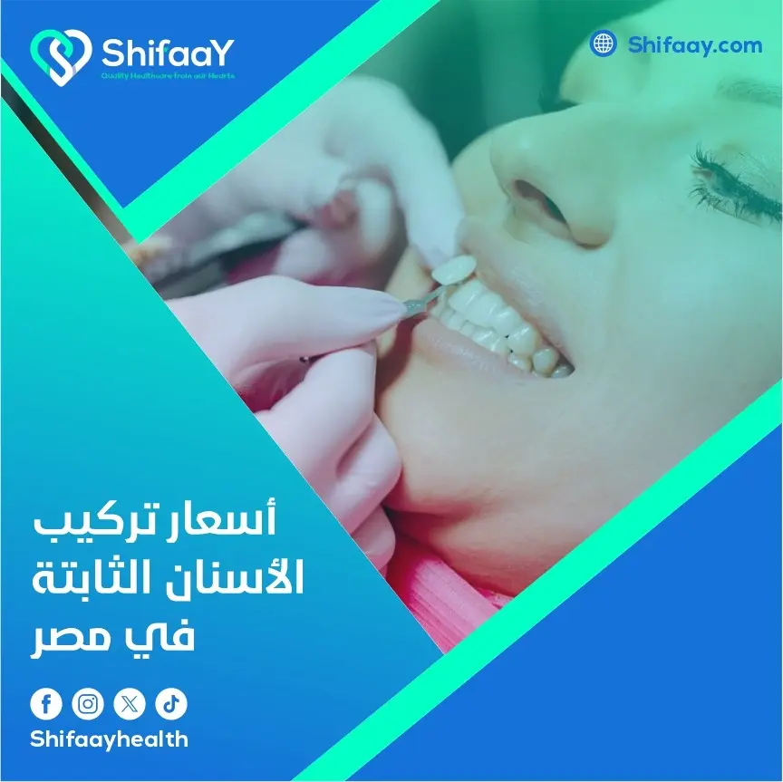 أسعار تركيب الأسنان الثابتة في مصر