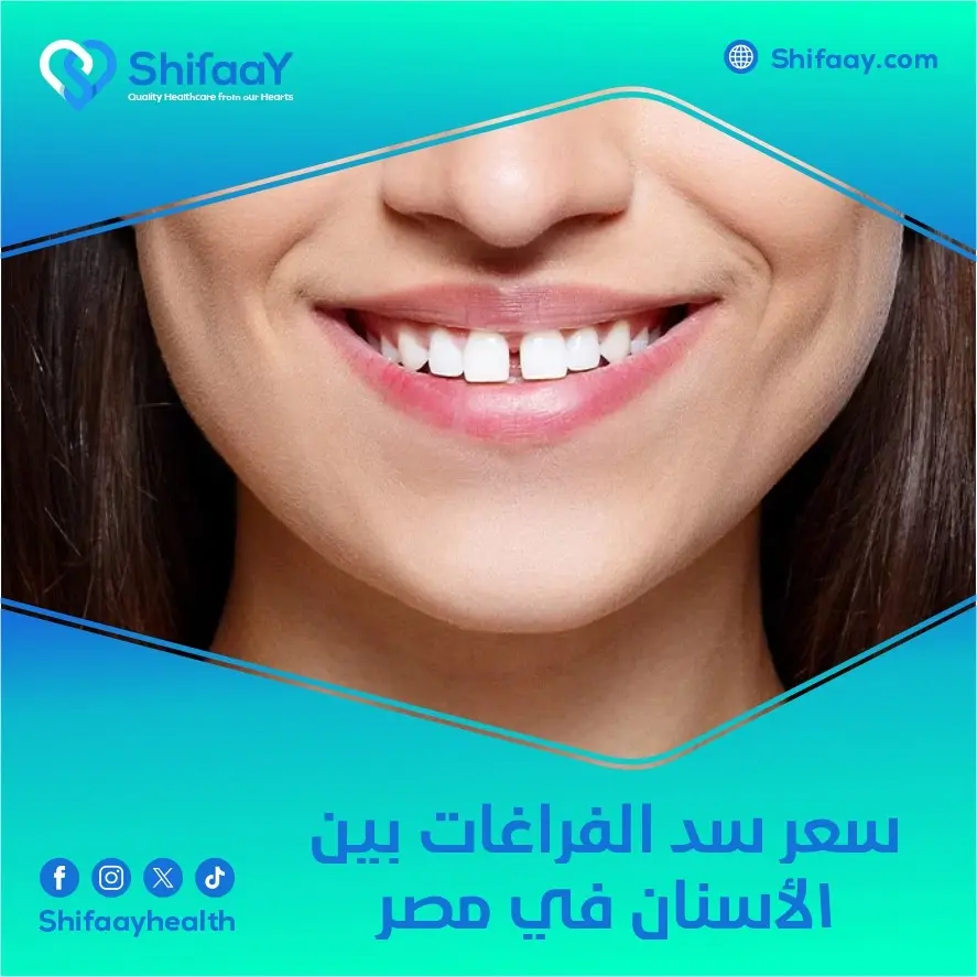 سعر سد الفراغات بين الأسنان في مصر