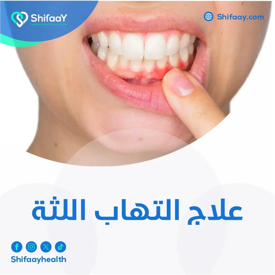 علاج التهاب اللثة