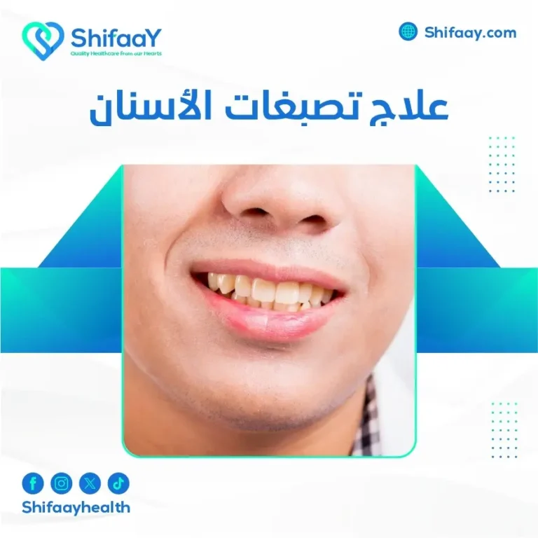 علاج تصبغات الأسنان