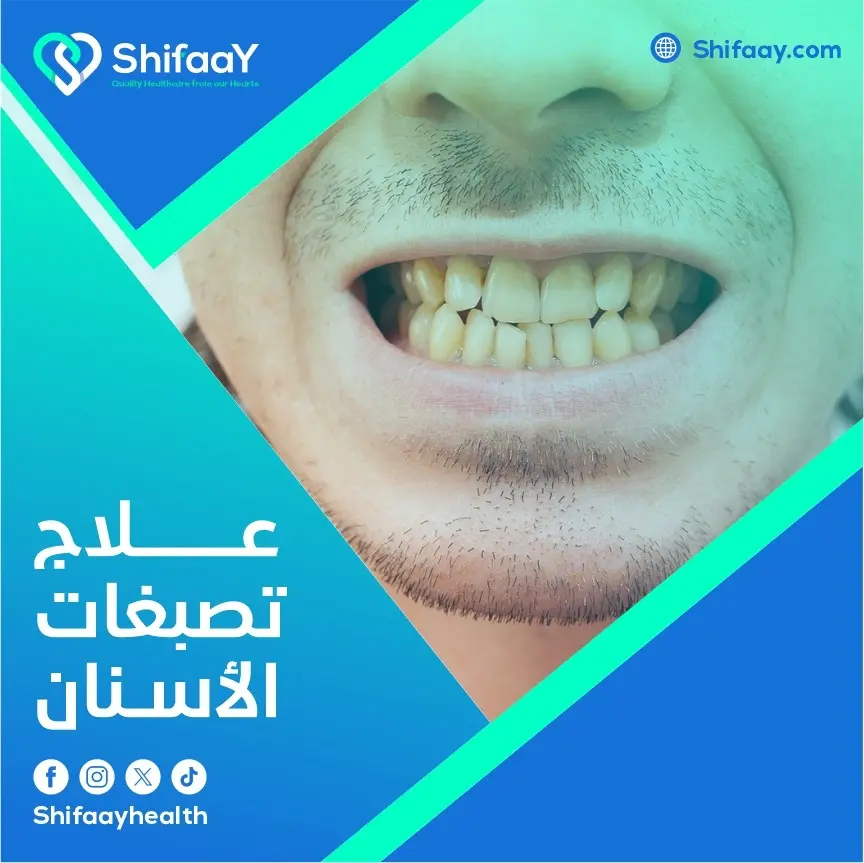 علاج تصبغات الأسنان 2 علاج تصبغات الأسنان