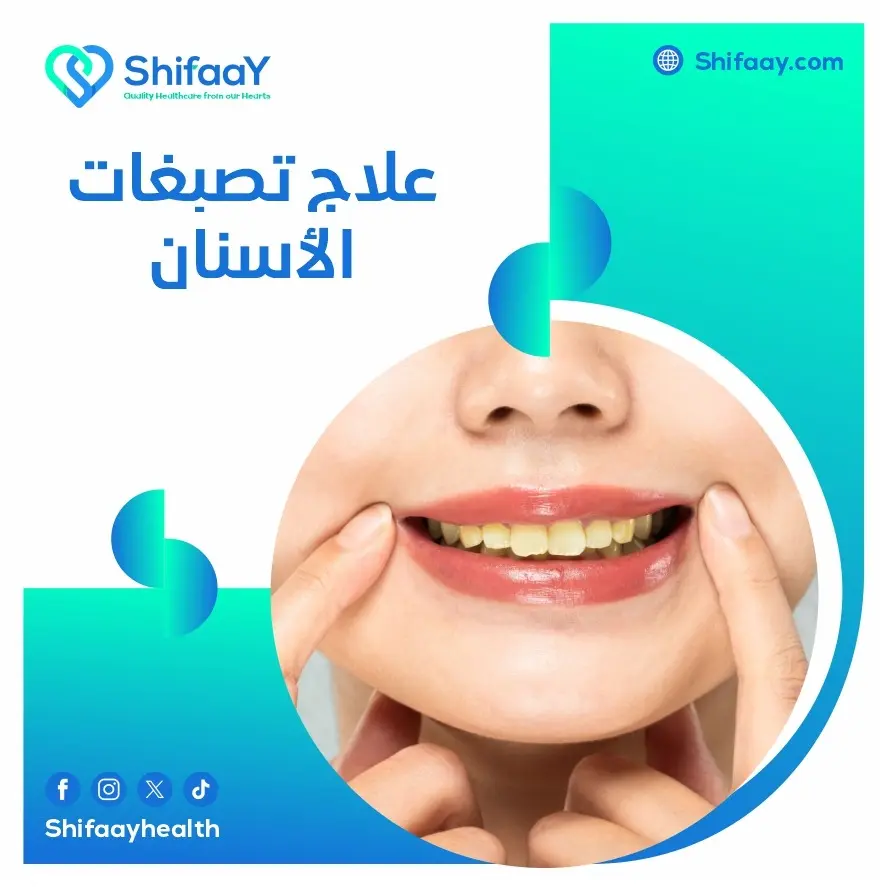 علاج تصبغات الأسنان 1 علاج تصبغات الأسنان