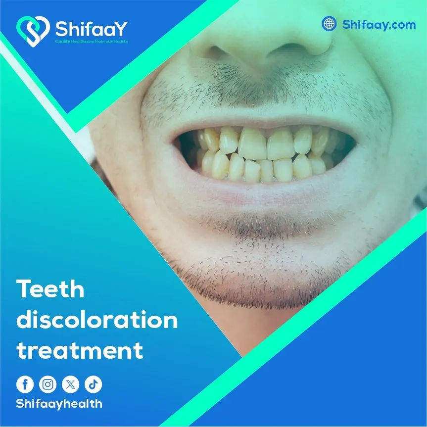 Teeth Discoloration Treatment