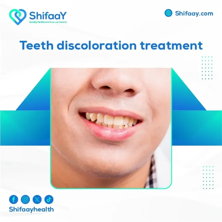 Teeth Discoloration Treatment