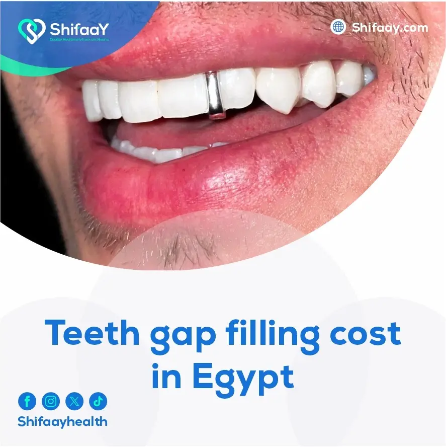 Teeth Gap Filling Cost in Egypt