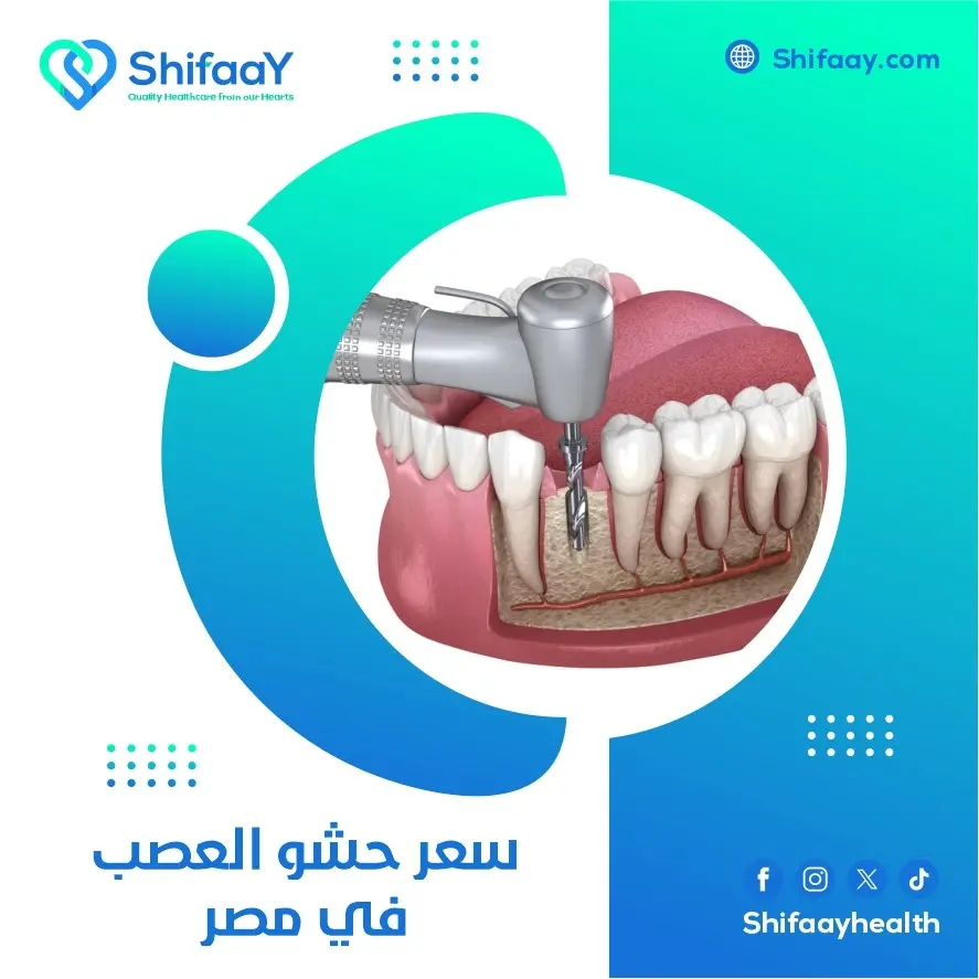 سعر حشو العصب في مصر